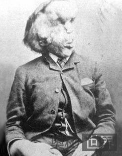 Joseph Merrick